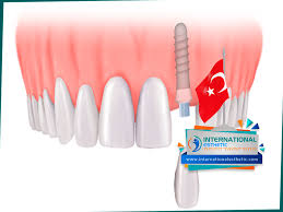 كم سعر زراعة الاسنان في تركيا