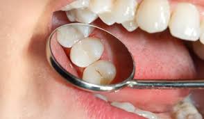 اضرار تلبيس الاسنان