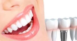 افضل مستشفي زراعة الاسنان في تركيا