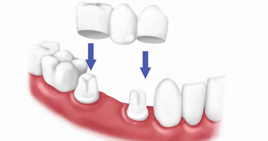 عمليات تجميل الاسنان قبل وبعد