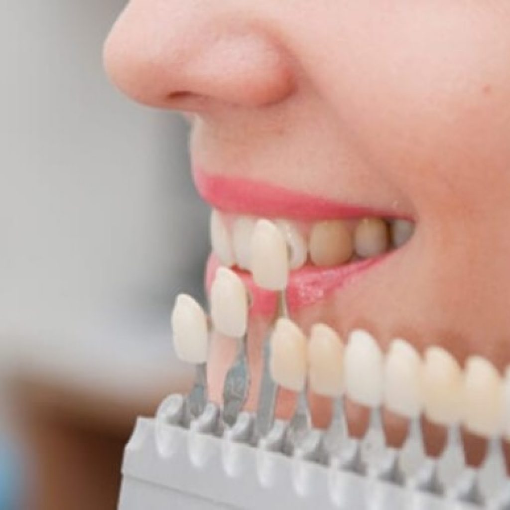 ما هي عدسات الاسنان
