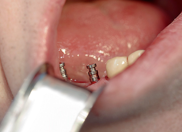 مخاطر زراعة الاسنان